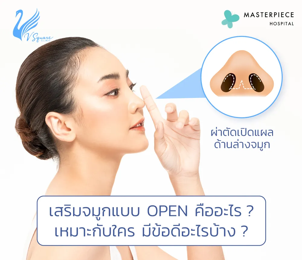 เสริมจมูกแบบโอเพ่น คืออะไร? อันตรายไหม? เหมาะกับใครบ้าง? เสริมจมูกแบบโอเพ่น คืออะไร? อันตรายไหม? เหมาะกับใครบ้าง?
