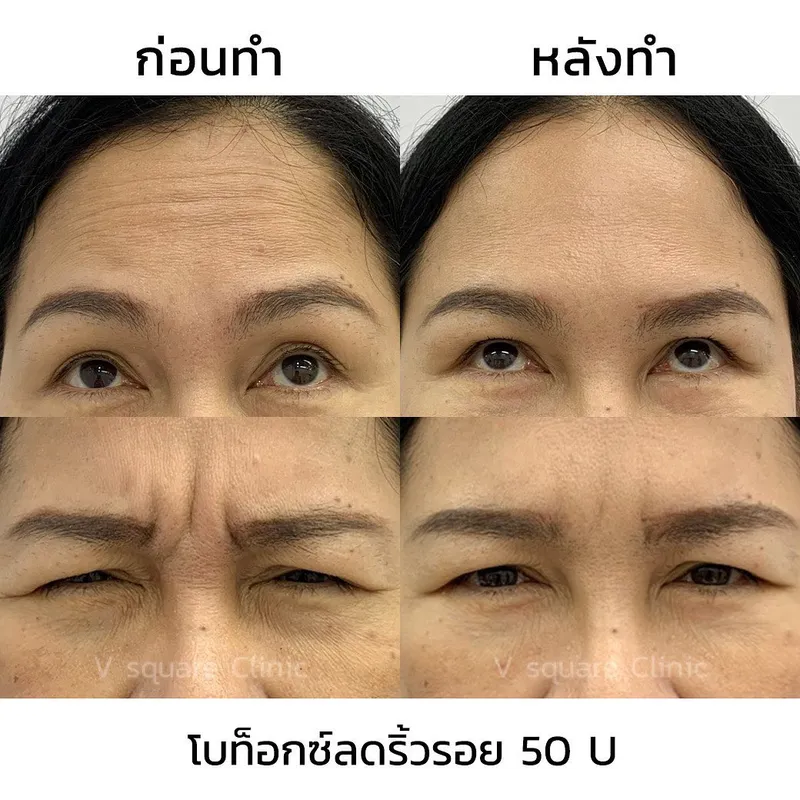 รีวิวฉีดโบลดริ้วรอยราคา3