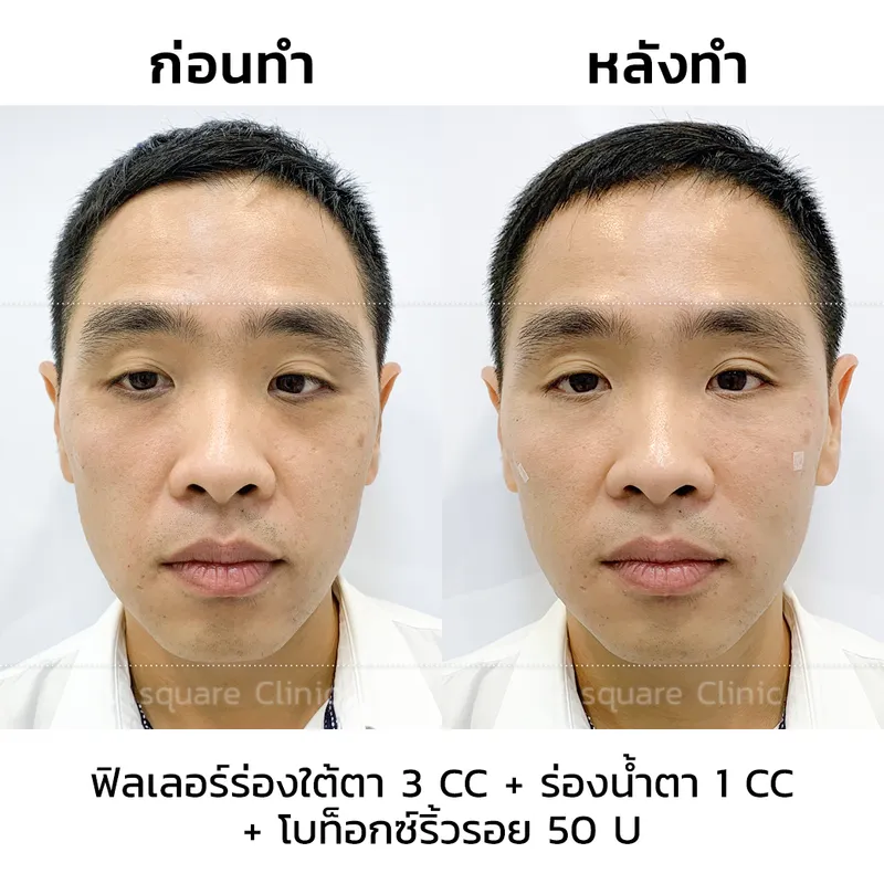 รีวิวฉีดโบลดริ้วรอยราคา4