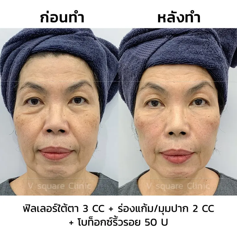 รีวิวฉีดโบลดริ้วรอยราคา5