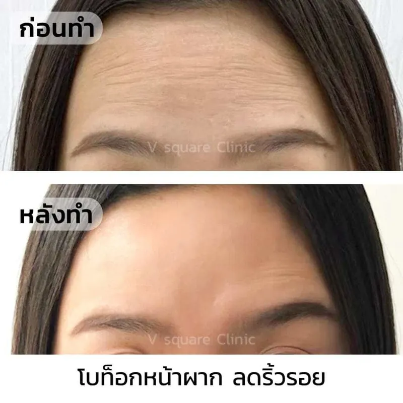 รีวิวฉีดโบลดริ้วรอยหน้าผาก1