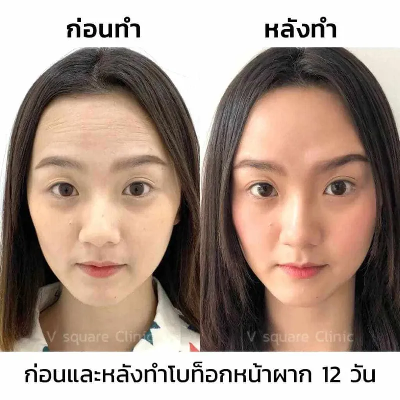 รีวิวฉีดโบลดริ้วรอยหน้าผาก2