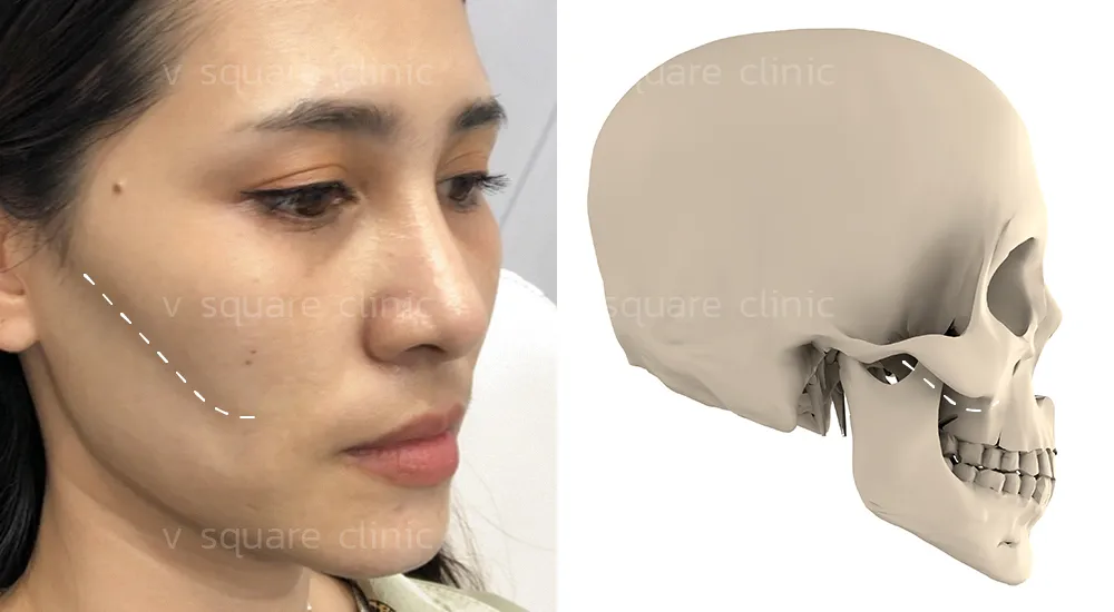 ลักษณะของการเกิดแก้มตอบ ดูอย่างไร