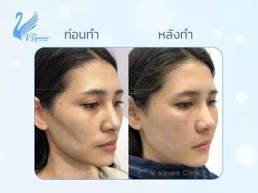 ฉีดฟิลเลอร์แก้มตอบ
