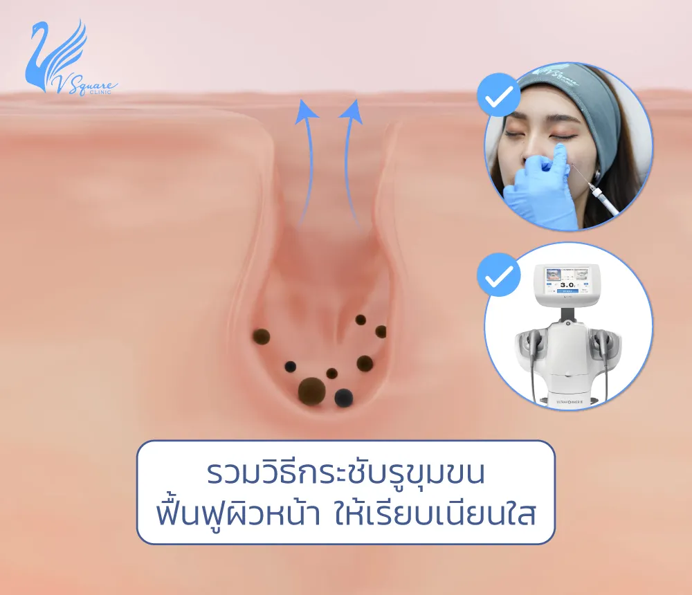 กระชับรูขุมขนวิธีไหนดี ? รูขุมขนกว้าง ป้องกันได้หรือไม่ ? ทำอย่างไร ? กระชับรูขุมขนวิธีไหนดี ? รูขุมขนกว้าง ป้องกันได้หรือไม่ ? ทำอย่างไร ?