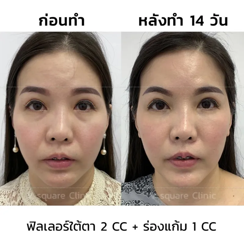 รีวิวฉีดฟิลเลอร์ใต้ตา 2 cc+ ร่องแก้ม 1 cc