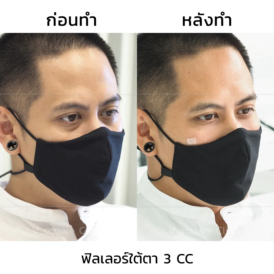 รีวิวฉีดฟิลเลอร์ใต้ตา 3 cc