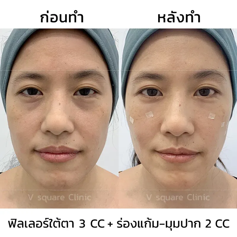 รีวิวฉีดฟิลเลอร์ใต้ตา 3 cc+ร่องแก้ม-มุกปาก 2 cc