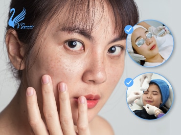 วิธีรักษาฝ้า