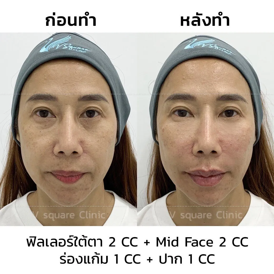 รีวิวฉีดฟิลเลอร์ juvederm