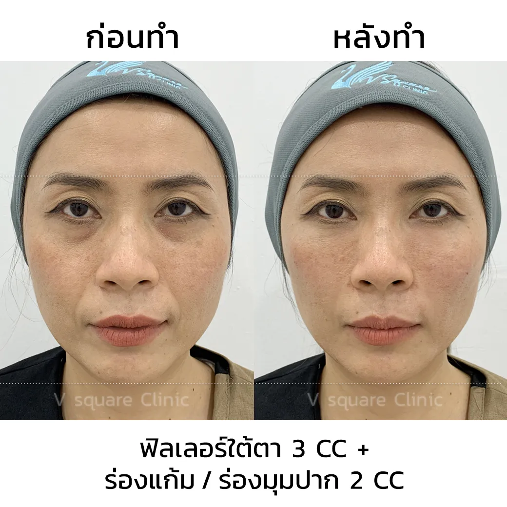 รีวิวฉีดฟิลเลอร์ juvederm(1)
