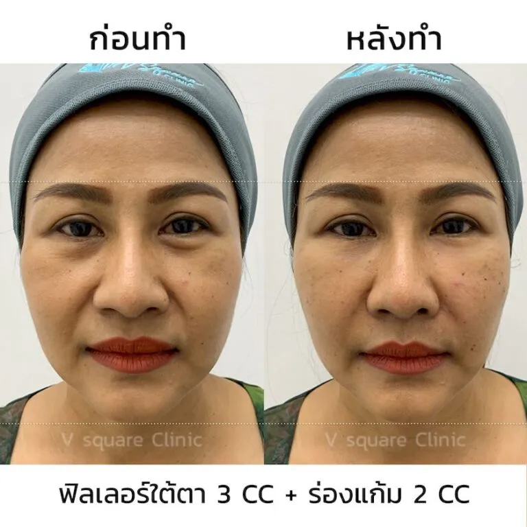 รีวิวฉีดฟิลเลอร์ juvederm(2)