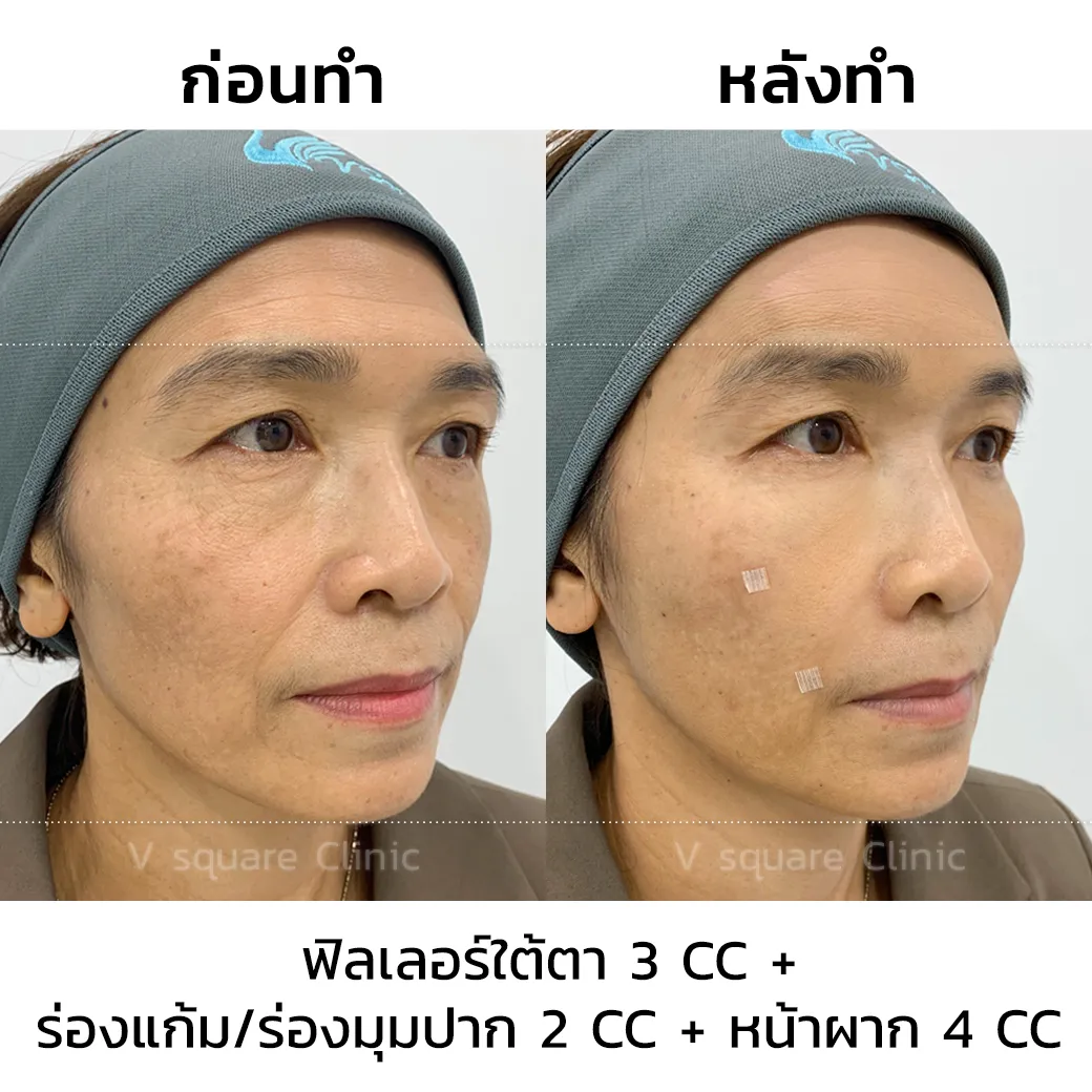 รีวิวฉีดฟิลเลอร์ juvederm(3)