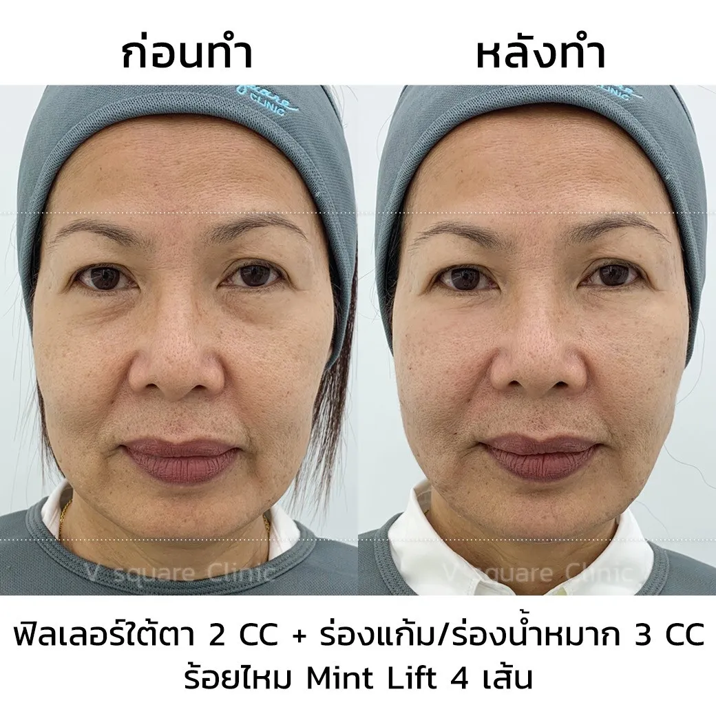 รีวิวฉีดฟิลเลอร์ juvederm(4)