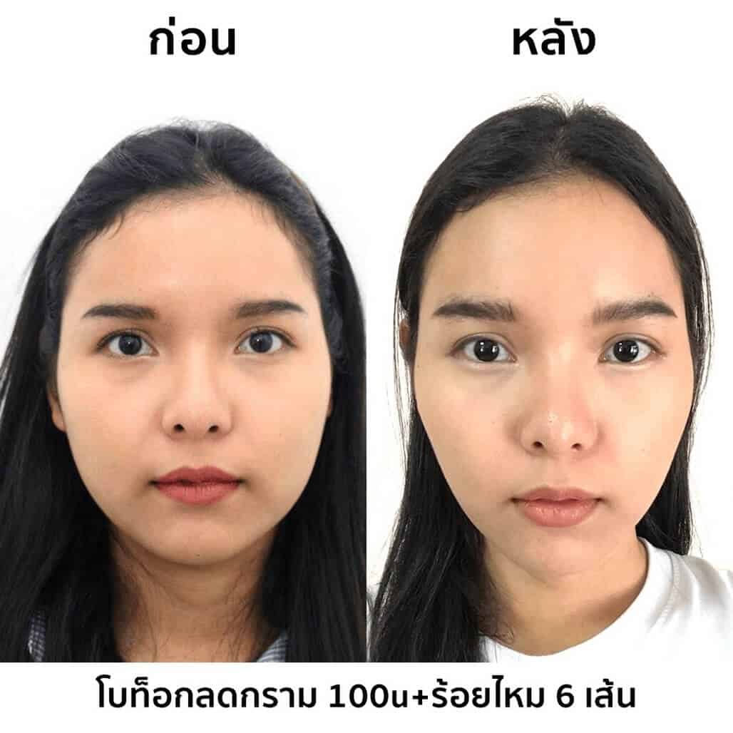 รีวิวโบท็อกลดกราม หน้าเรียว