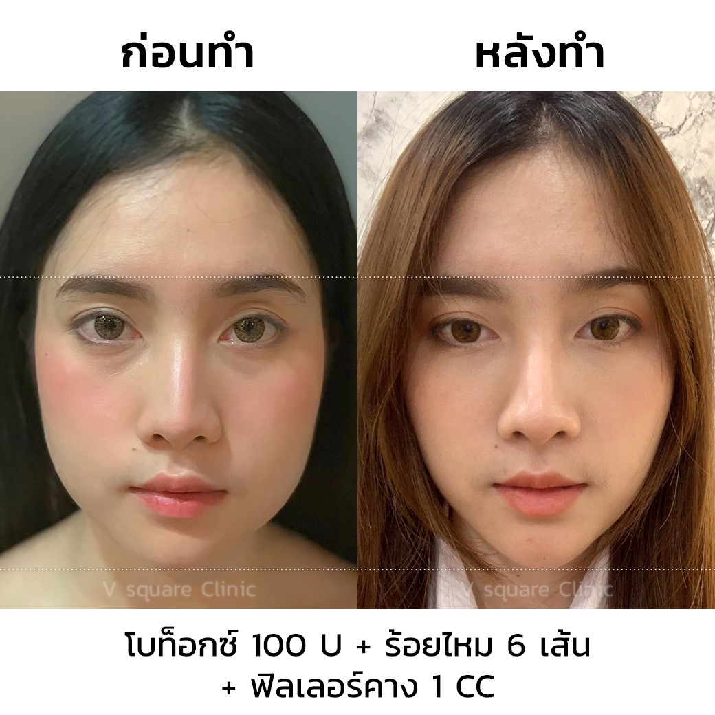 รีวิวโบท็อกลดกราม หน้าเรียว