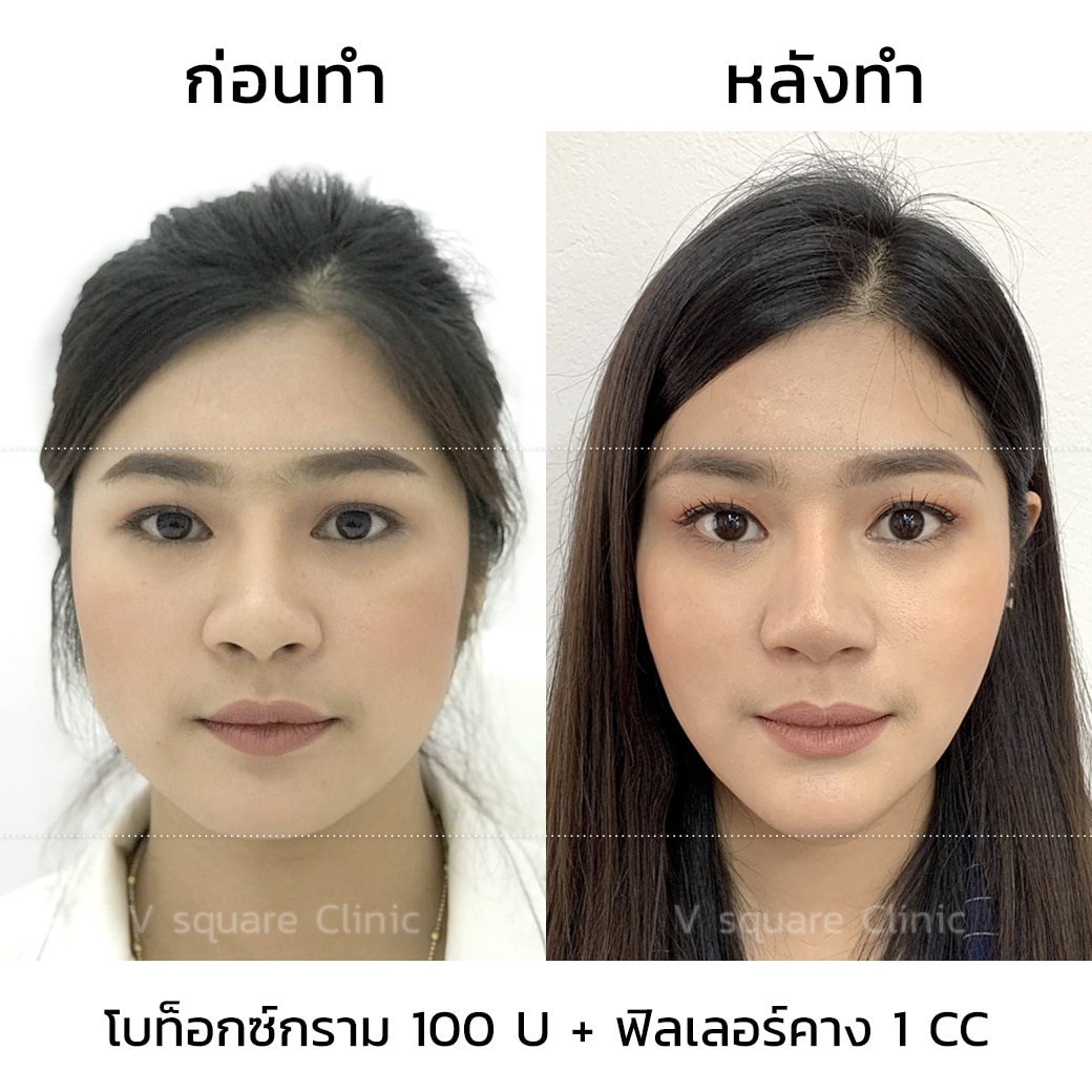 รีวิวโบท็อกลดกราม หน้าเรียว