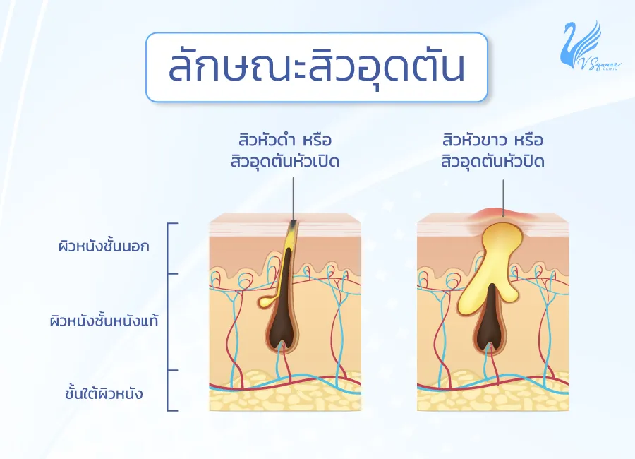 สิวอุดตัน รักษาวิธีไหนได้บ้าง สาเหตุการเกิดสิวคืออะไร ป้องกันอย่างไร ? สิวอุดตัน รักษาวิธีไหนได้บ้าง สาเหตุการเกิดสิวคืออะไร ป้องกันอย่างไร ?