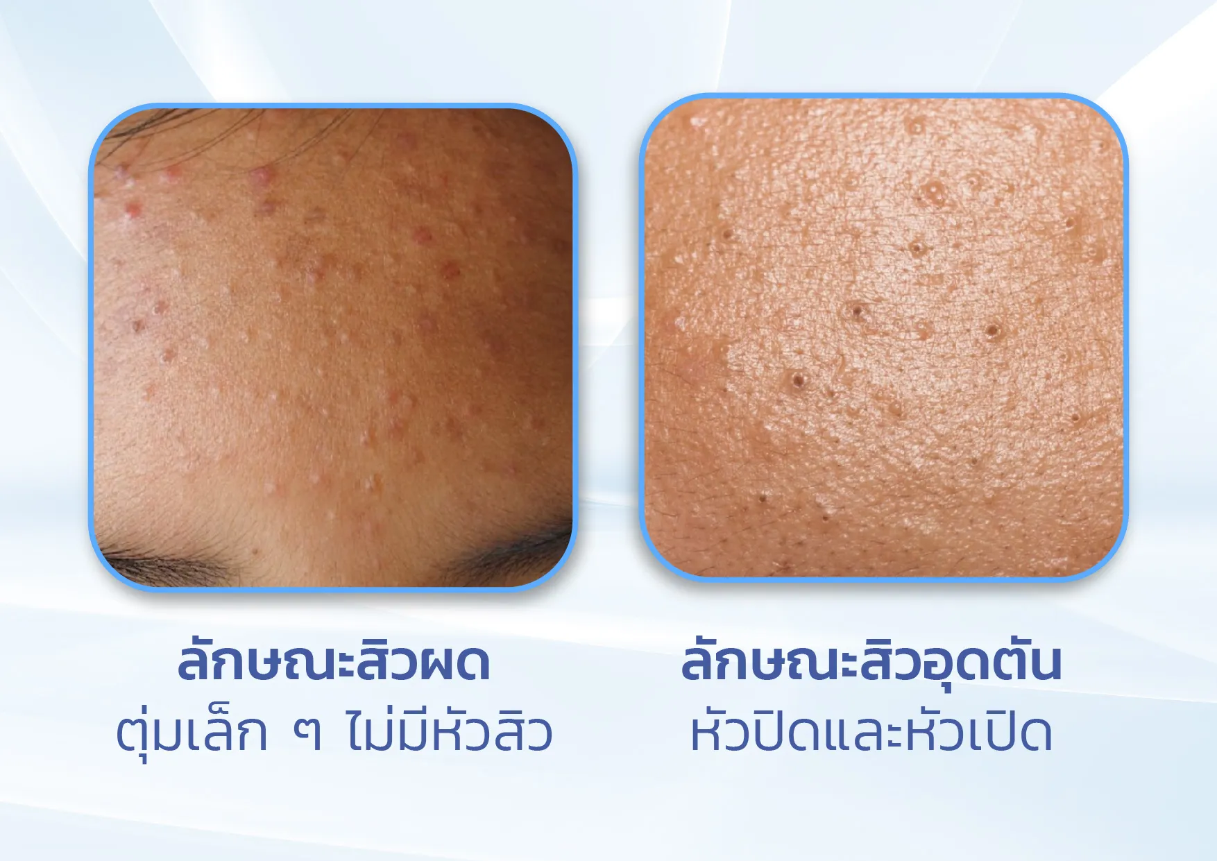 ความแตกต่างของสิวผดและสิวอุดตัน