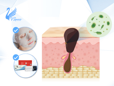สิวอุดตัน-สาเหตุเกิดจากอะไร-370x277