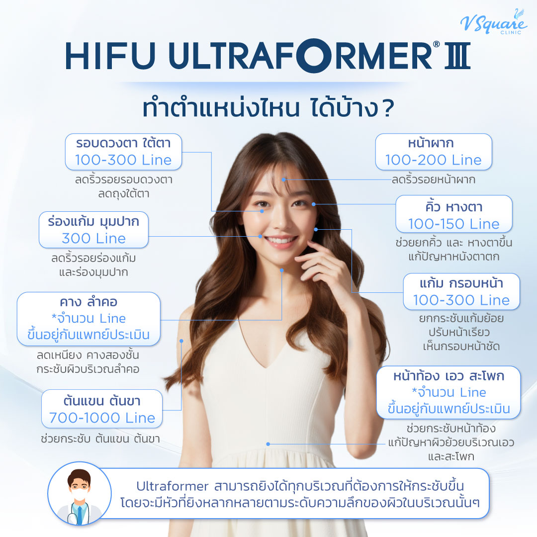 ตำแหน่งทำ Ultraformer III