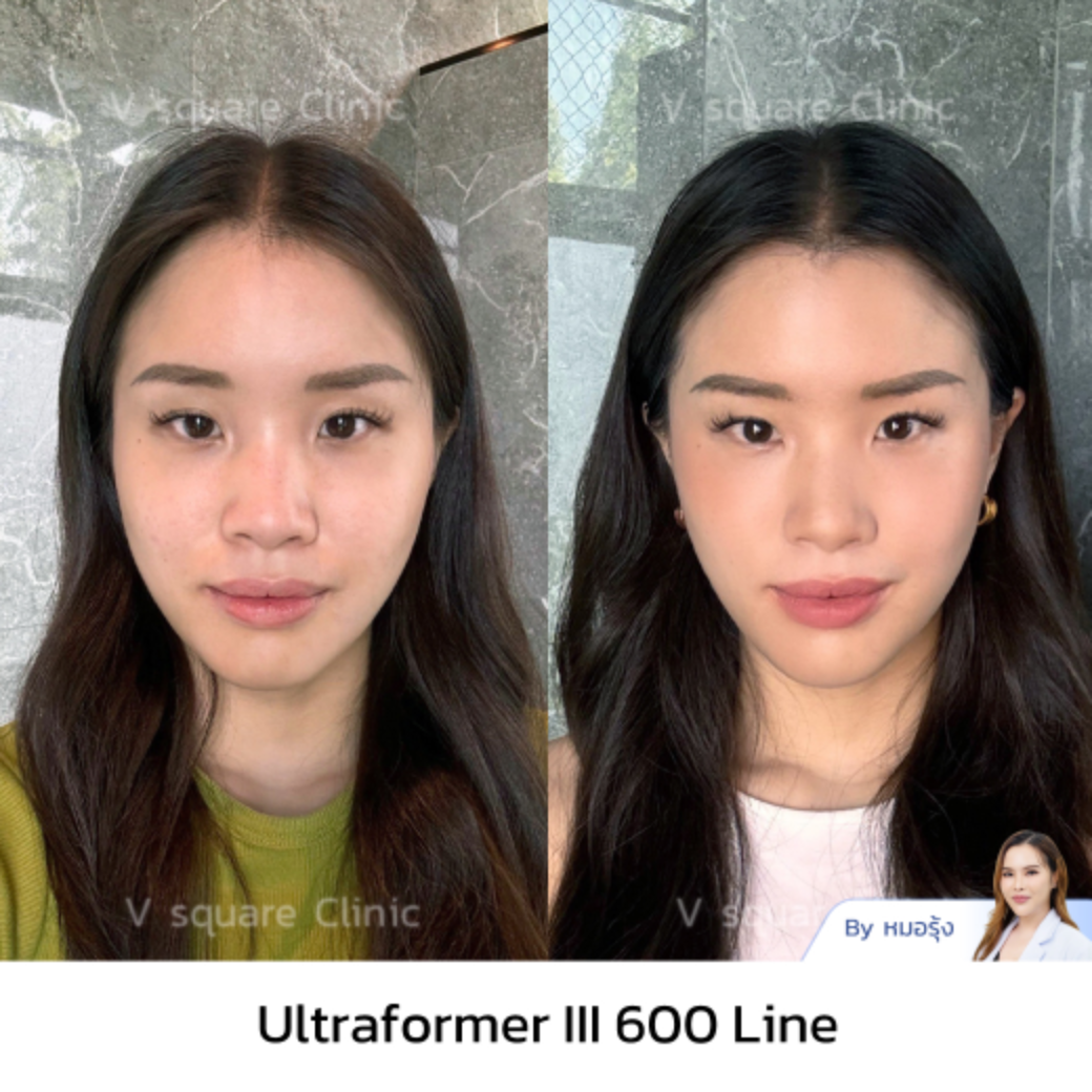ริวิวUltraformer III_คุณแน้น Influencer โดย พญ.นฤมล จิตณรงค์ เลข ว. 48015
