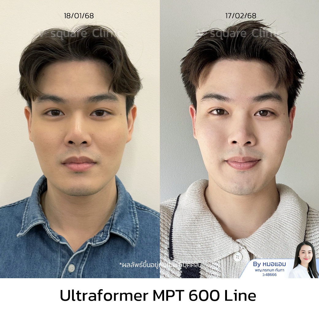 รีวิวUltraformer III_ทอย