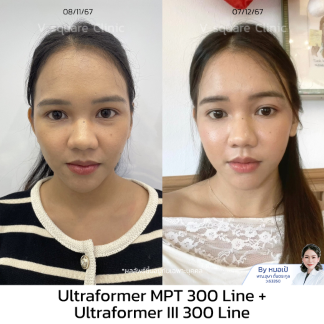 รีวิวUltraformer III_มายด์