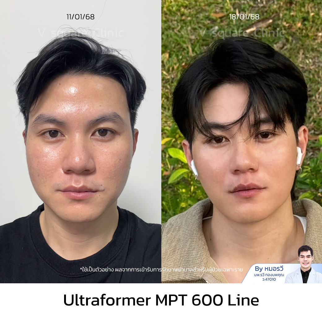 รีวิวUltraformer III_แฟร้ง