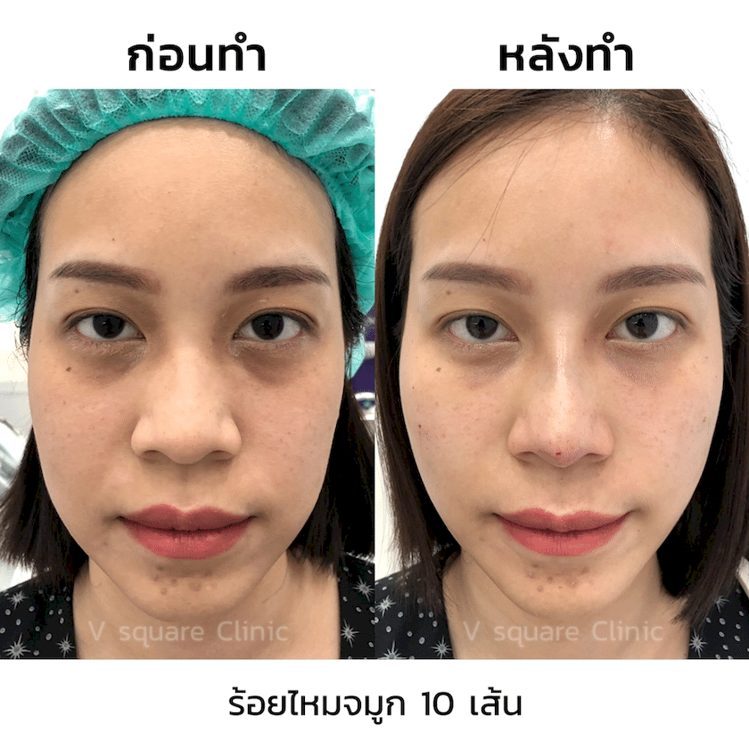 รีวิวร้อยไหมจมูก