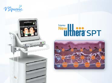 Ulthera SPT 370x277