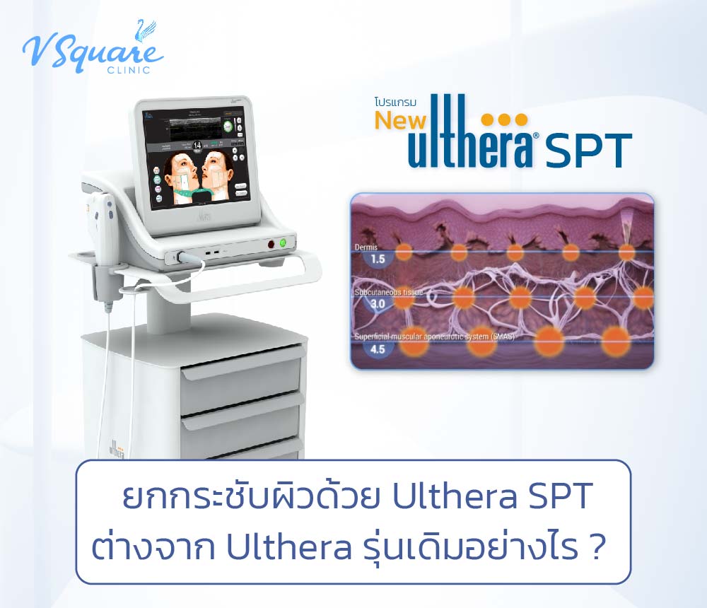 Ulthera SPT
