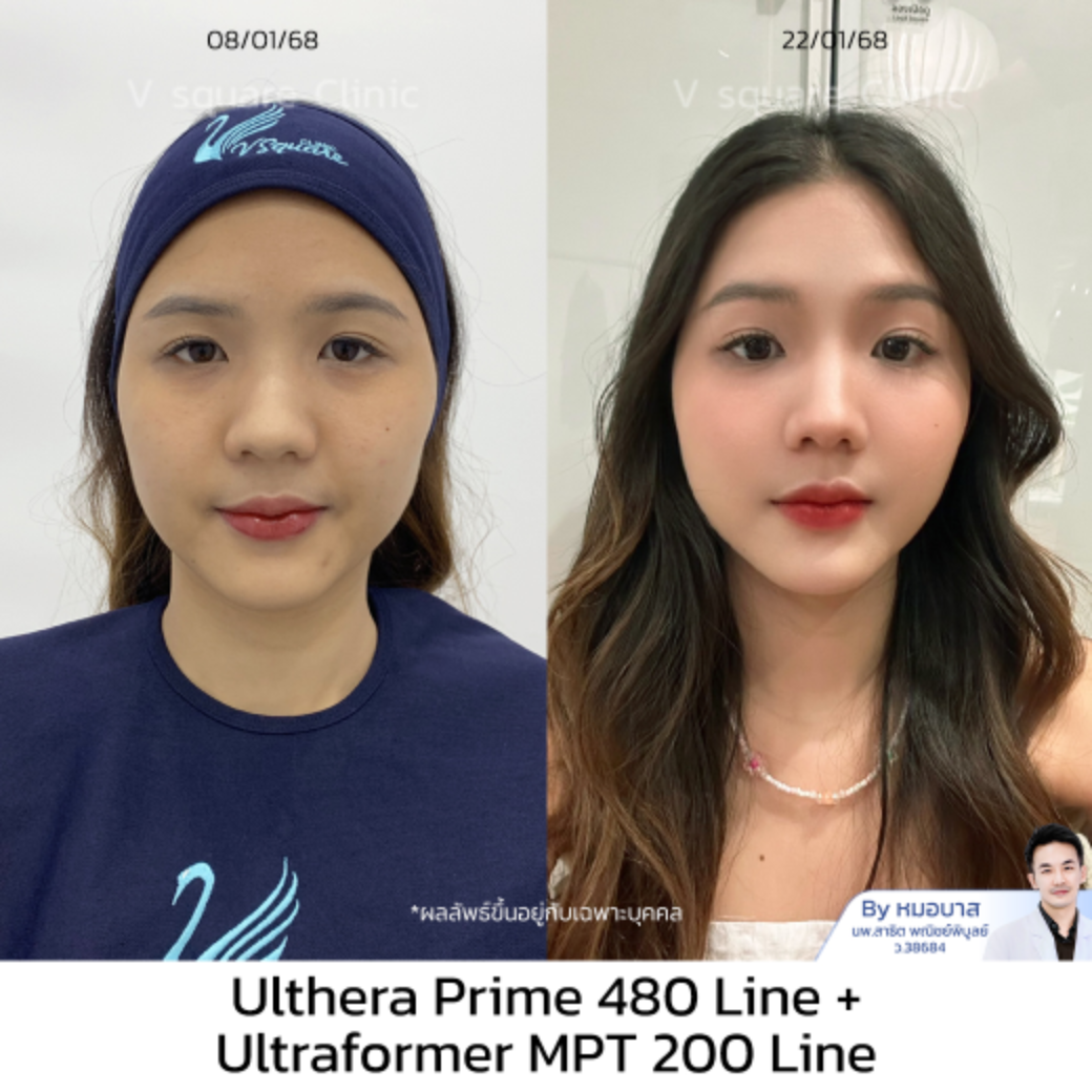 รีวิว Ulthera Prime