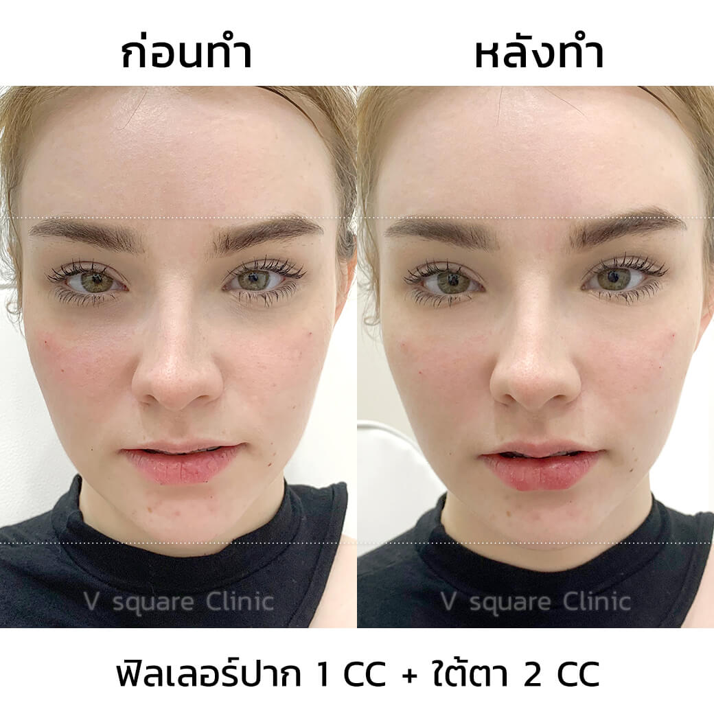 รีวิวฉีดฟิลเลอร์เห็นผลทันทีหลังทำ_เจสซี่