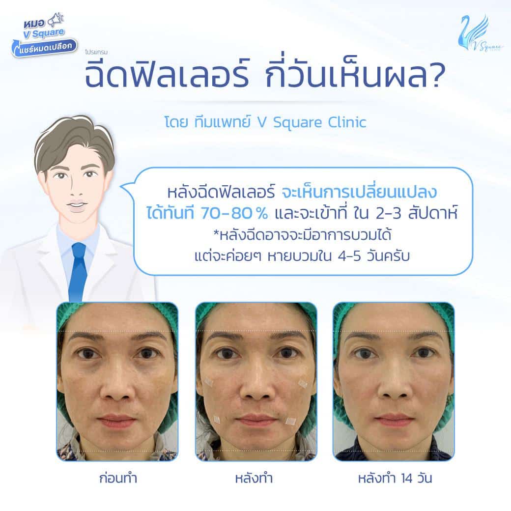 ฉีดฟิลเลอร์กี่วันเห็นผล