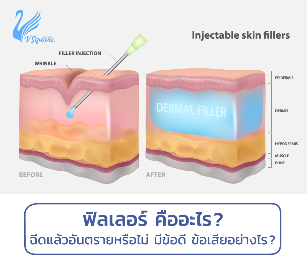 ฟิลเลอร์คืออะไร