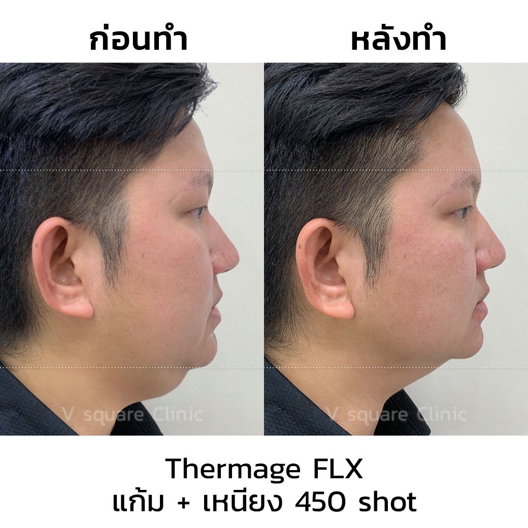 thermage before after