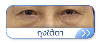 ถุงใต้ตา