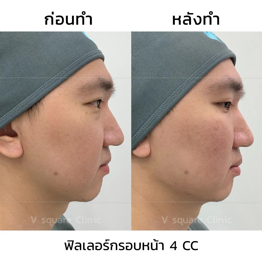 ฟิลเลอร์กรอบหน้า