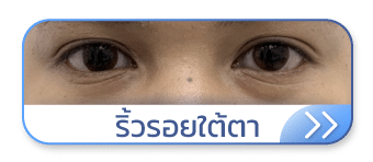 ริ้วรอยใต้ตา