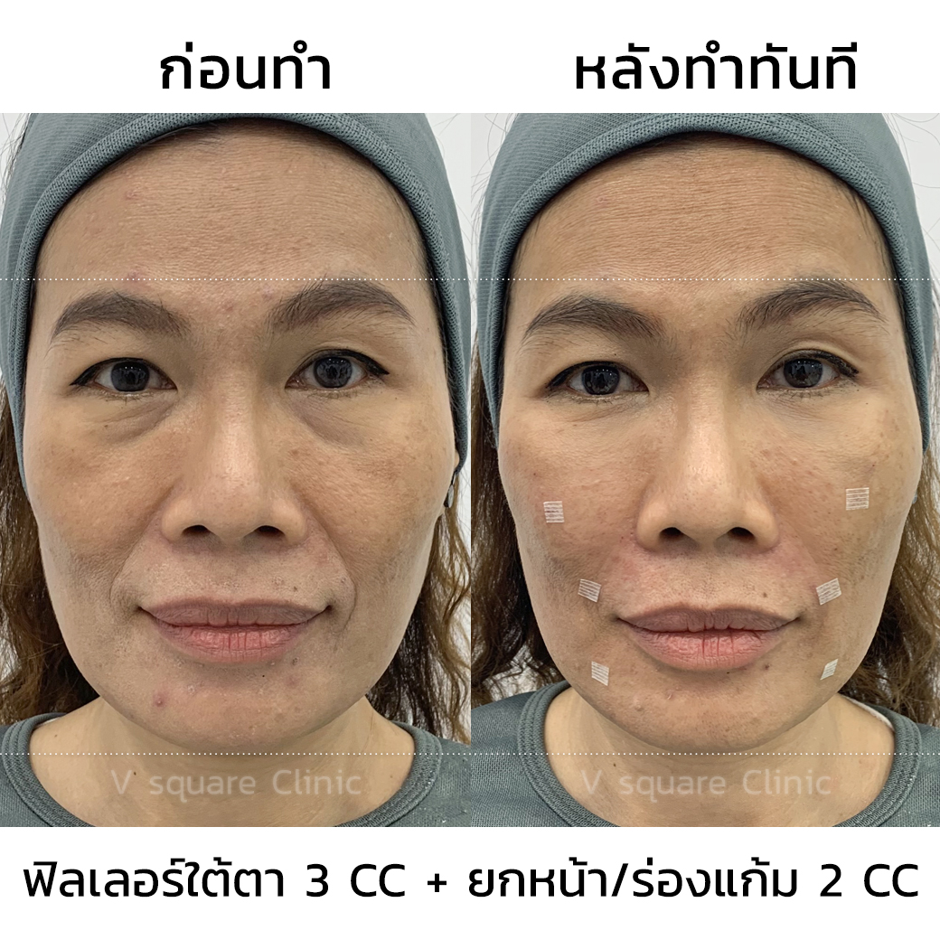 รีวิว ฟิลเลอร์ยกหน้า