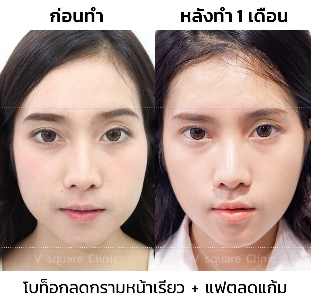 รีวิวฉีดเมโสแฟตแก้ม+โบท็อก