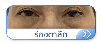 ร่องตาลึก