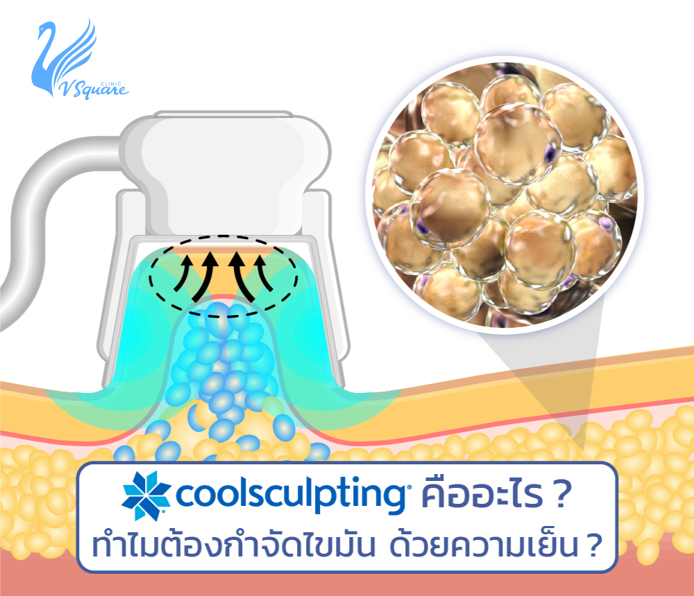 coolsculpting คืออะไร