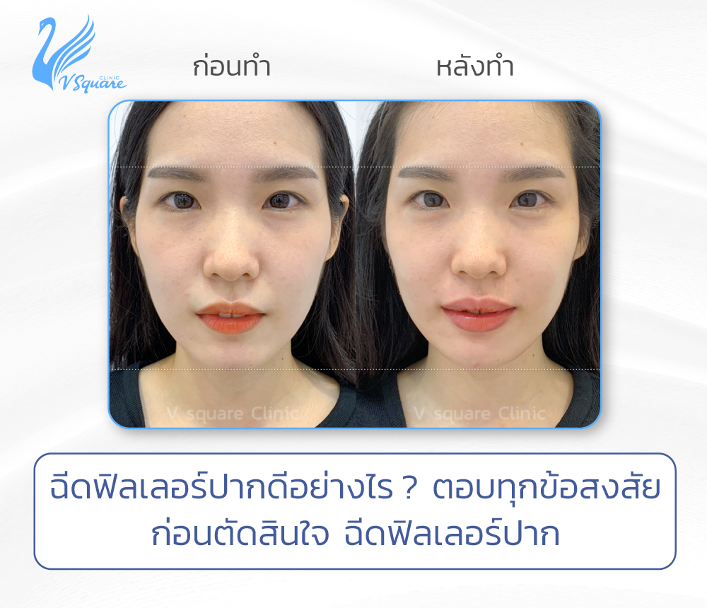 ฉีดฟิลเลอร์ปากดีอย่างไร
