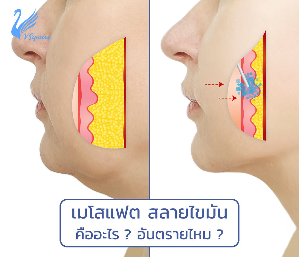 รูปบทความ_ฉีดเมโสแฟตคืออะไร1000x860