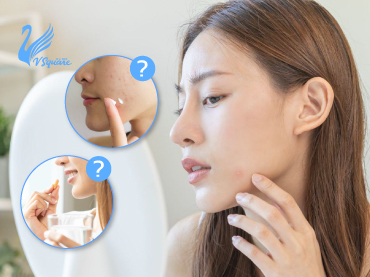 วิธีลดรอยสิว-มีแบบไหนบ้าง-370x277