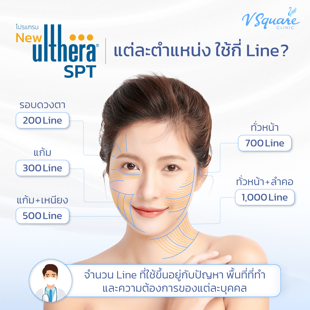 Ulthera จำนวนช็อต แต่ละตำแหน่ง