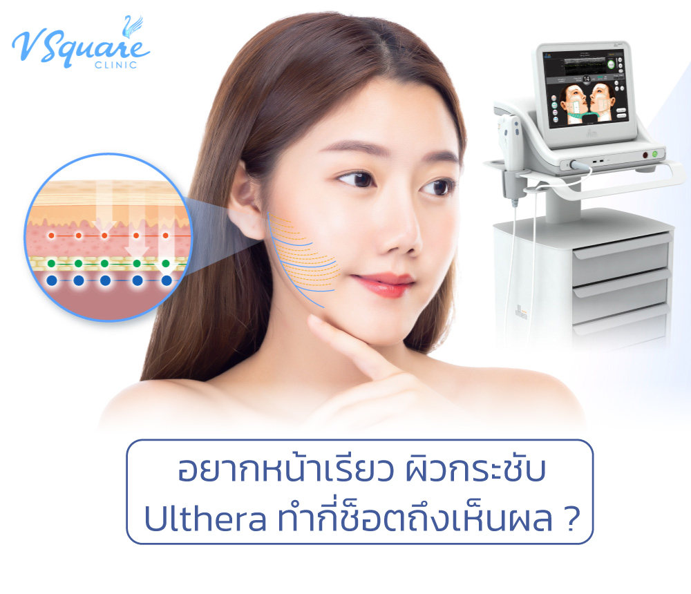 Ulthera ทํากี่ช็อต