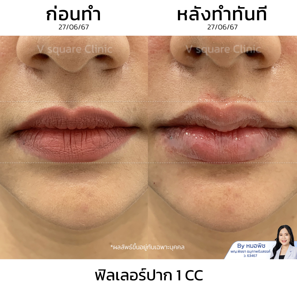 รีวิวฉีดฟิลเลอร์ปาก 1 CC ที่ V Square Clinic (5)